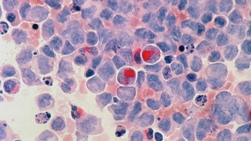 Microscope view of stained tumor cells