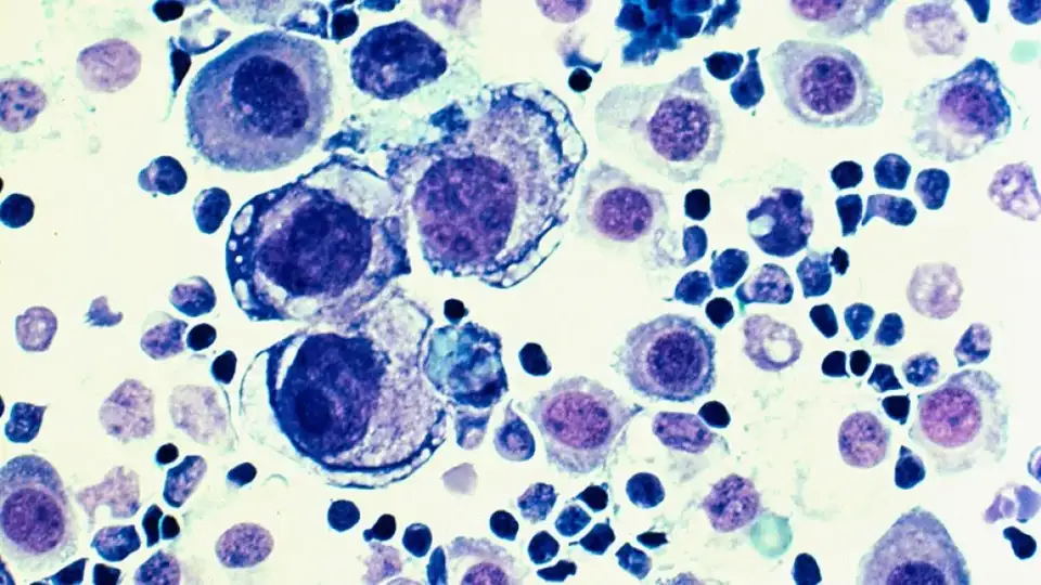 Cancer cells under the microscope